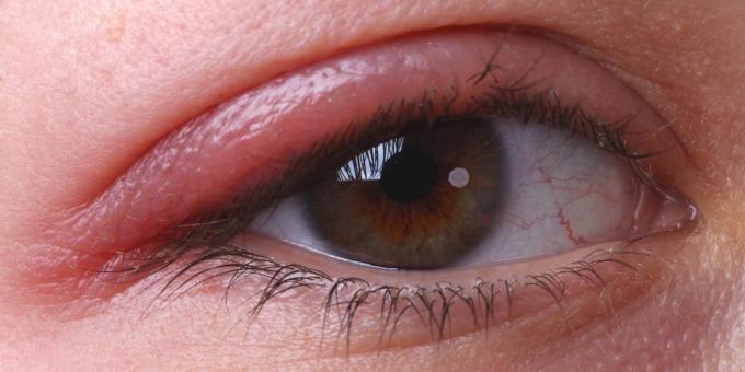 क्यों खुजली आँखें: ब्लेफेराइटिस