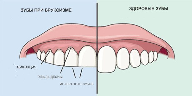 दांत पीस: स्वस्थ दांत और दांत ब्रुक्सिज्म दौरान