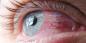 नेत्रश्लेष्मलाशोथ: क्यों आंखें लाल होना और उन्हें इलाज के लिए कैसे