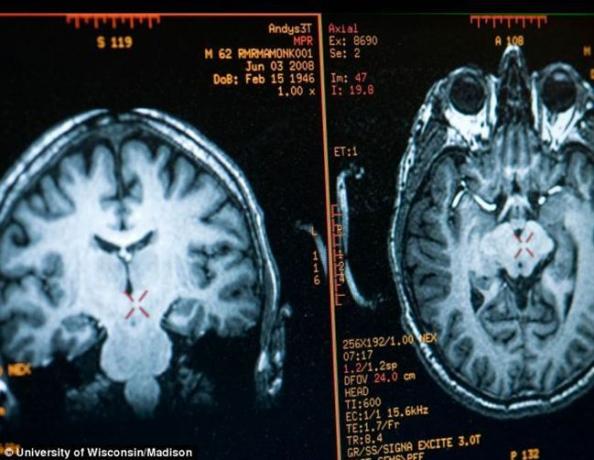 मस्तिष्क मैथ्यु रिकार्ड छवि एमआरआई द्वारा प्राप्त