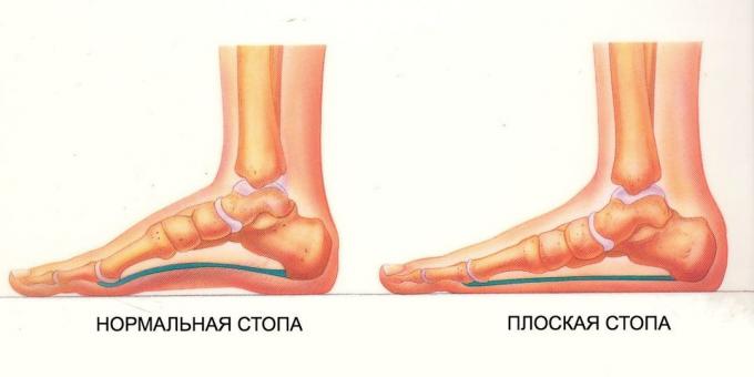 सामान्य और फ्लैट पैर: फ्लैट पैर के लिए व्यायाम