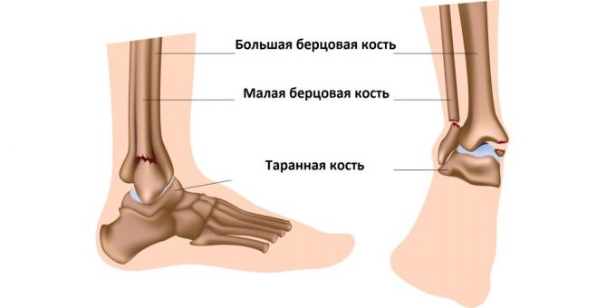 टखने के फ्रैक्चर हड्डियों को प्रभावित करते हैं जो टखने के जोड़ को बनाते हैं