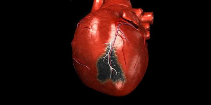 दिल का दौरा, के लक्षण है जिसके लिए आप एक एम्बुलेंस कॉल करने की आवश्यकता