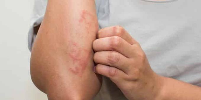 एलर्जी के लक्षणों के साथ अपने लक्षणों सत्यापित करें